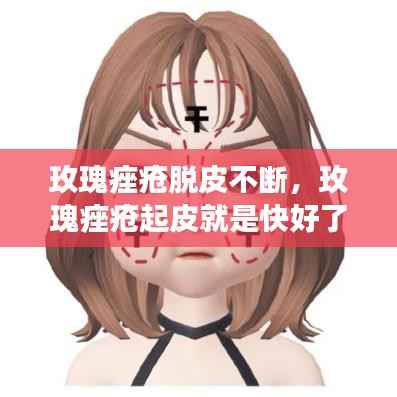 玫瑰痤疮脱皮不断,玫瑰痤疮起皮就是快好了吗